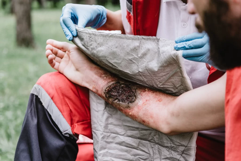 Chemical Burn Lawyer