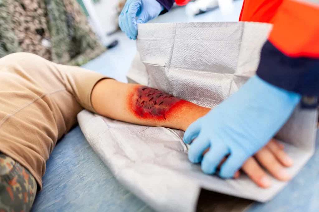 Sugar Land Burn Injury Attorney